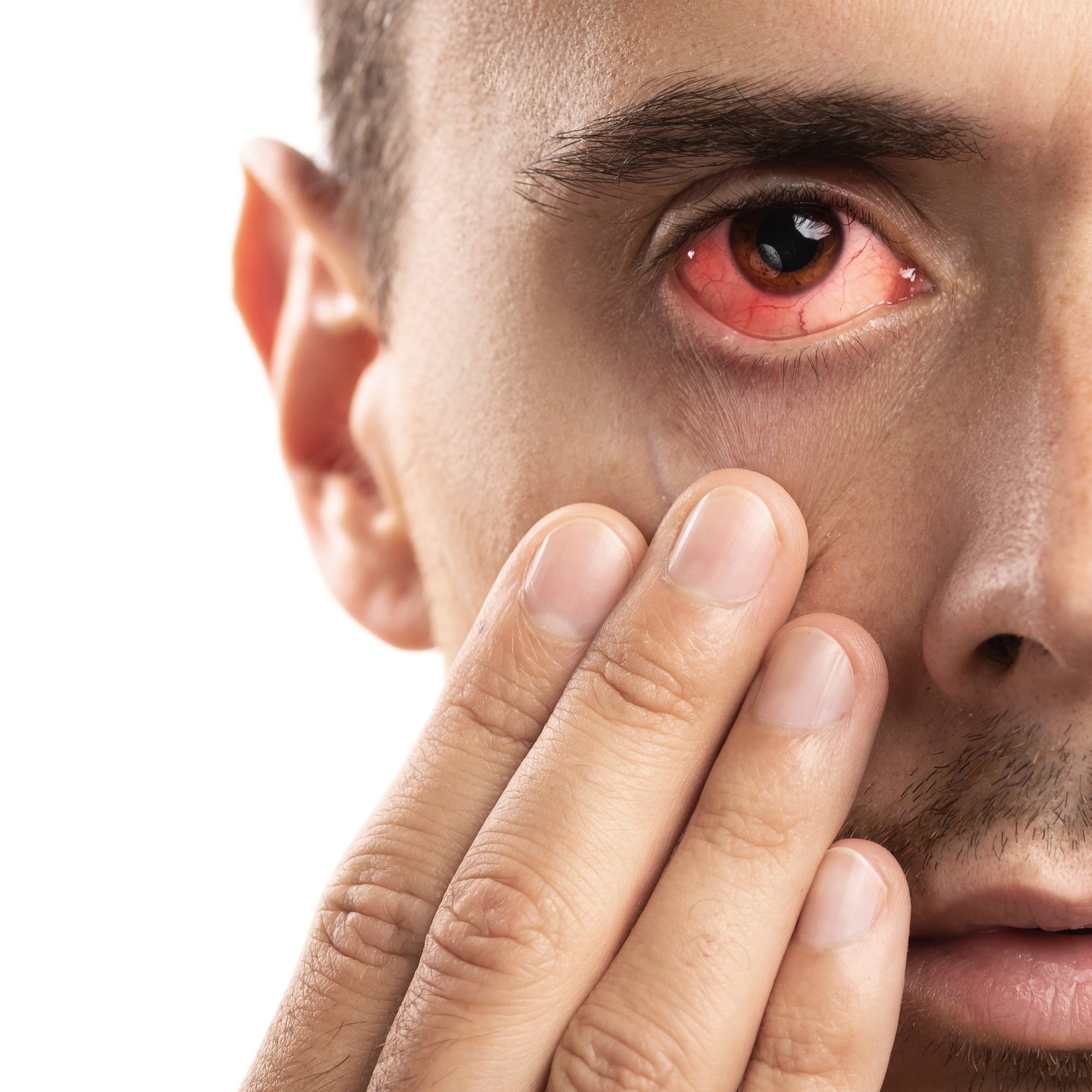 Man with the Subconjunctival hemorrhage in his eye